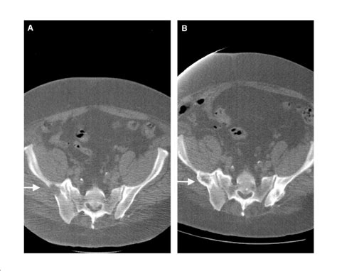 A Lytic Lesion In The Right Ischium Arrow First Seen In January 2001