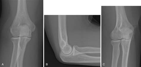 The Elbow Radiology Key