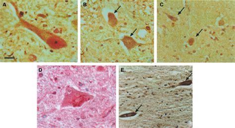 Ae Immunohistochemistry Of Ventral Horn Motor Neurons In Als Tissue Download Scientific