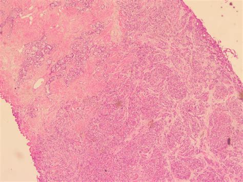 A Lung Adenocarcinoma Metastasis Arrow Lung Adenocarcinoma Sites Download Scientific