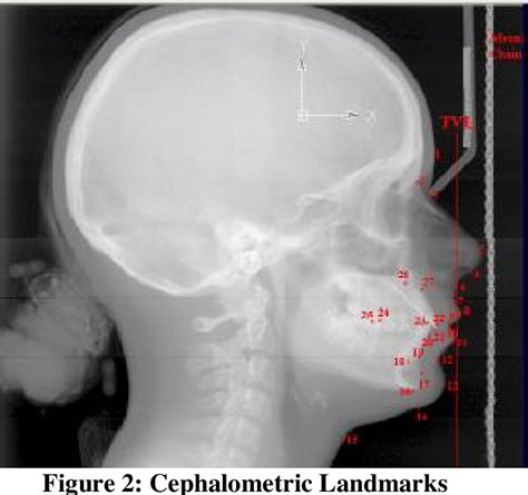 Pdf Soft Tissue Cephalometric Norms For A Sample Of Iraqi Adults With Class I Normal Occlusion