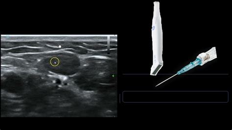 Ultrasound Guided IV Access | Videos tutorial, Ultrasound, Tutorial