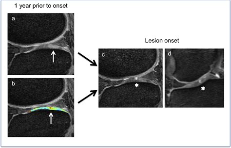 Knee Cartilage Grown In Lab at Odessa Francis blog