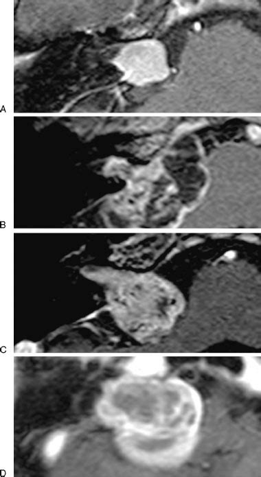 The Classification Of Tumor Localization In The Internal Auditory Canal