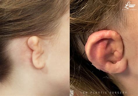 Ear Reconstruction Before After Photos Sage Plastic Surgery