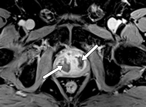 Prostatic Artery Embolization Indications Preparation Techniques