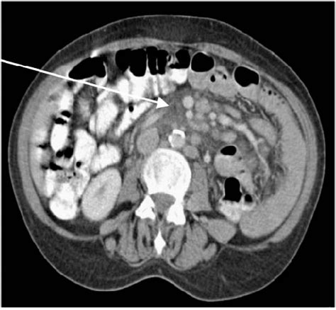 Axial Abdominal Ct Image Showing Mesenteric Fat Infiltration Arrow In