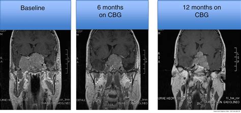 Clinically Non Functioning Pituitary Adenomas Pathogenic Diagnostic