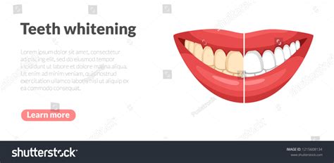 Teeth Whitening Toothy Smile Before After Stock Vector Royalty Free