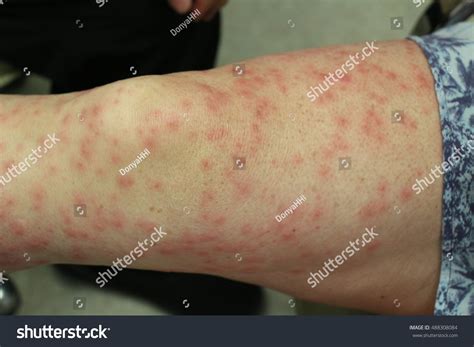 Skin Rashes Contact Allergic Reaction Stock Photo 488308084 | Shutterstock