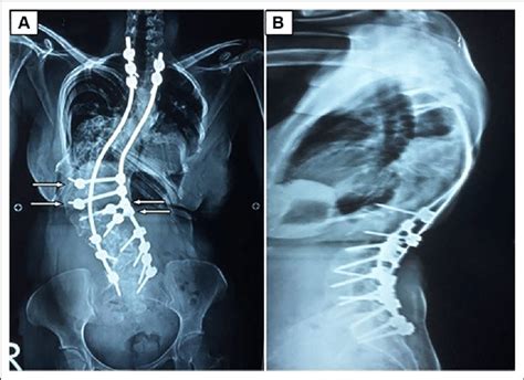 Anteroposterior A And Lateral B 3 Year Postoperative Radiographs