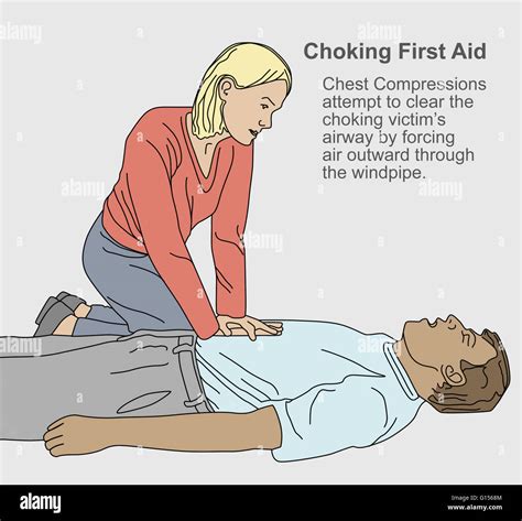 A First Aid Illustration On How To Help A Person Who Is Choking By Doing Chest Compressions