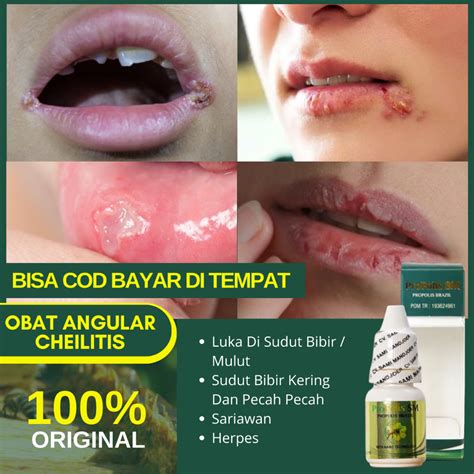 Jual Obat Luka Di Sudut Bibir Mulut Angular Cheilitis Sudut Bibir