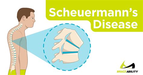 Scheuermann’s Disease: The Truth About Your Child’s Hunched Back