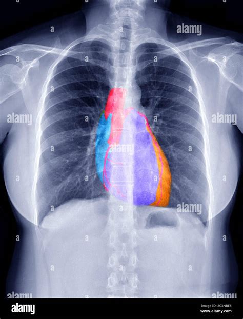 Plain Film X Ray Principles Interpretation Teachmeanatomy Off