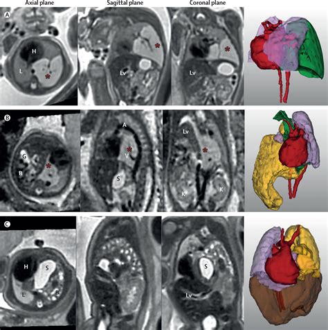 Fetal Body Mri And Its Application To Fetal And Neonatal Treatment An