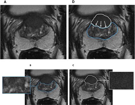 Multiparametric Magnetic Resonance Imaging For The Detection Of