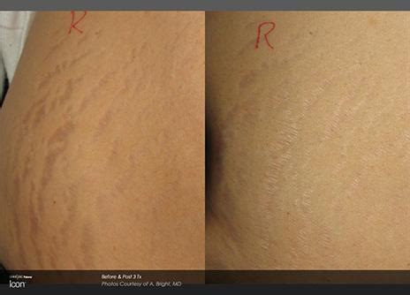 Laser Stretch Mark Removal Gallery - Newport Beach, CA: Coastline ...