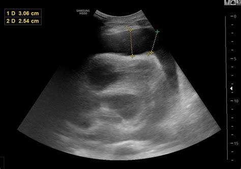 Pericardial Effusion Ultrasound