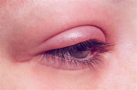 How To Reduce Swelling On Eyelid Sadconsequence Giggmohrbrothers