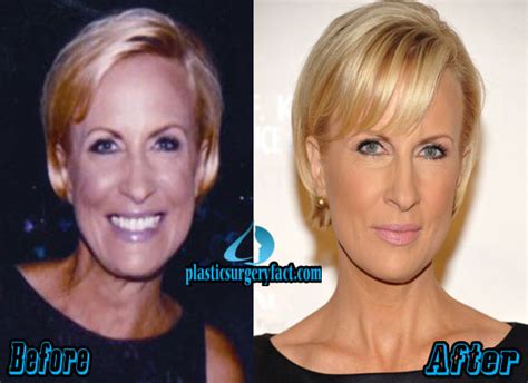 Mika Brzezinski Plastic Surgery Before and After Pictures