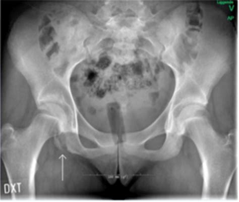 Figure 1 From Surgical Fenestration And Rehabilitation Of A Sports