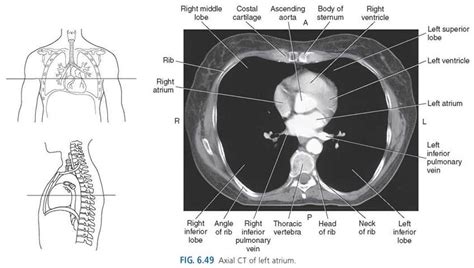 Cross Sectional Ct Thorax Anatomy