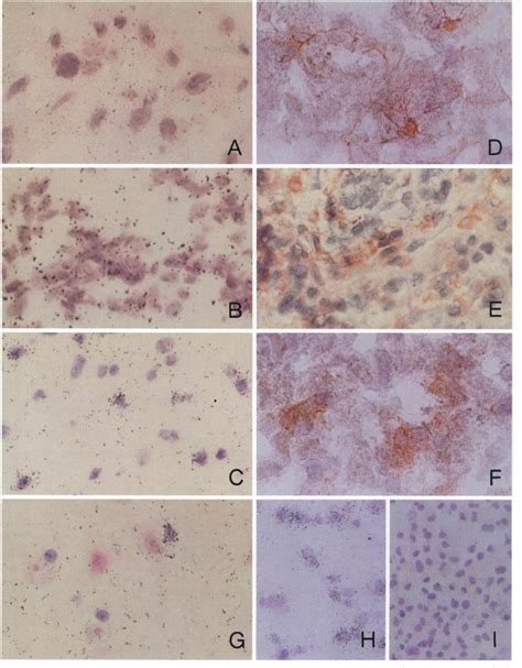 Figure From Platelet Derived Growth Factor And Its Receptors In Human