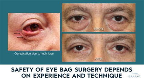 How Safe Is Under Eye Bag Removal Surgery Dr Prasad Blog