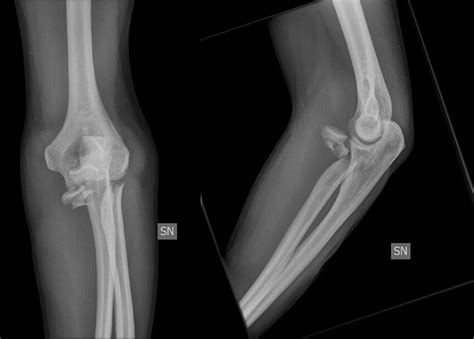 Radiographs Of A Comminuted Radial Head Fracture Download Scientific Diagram