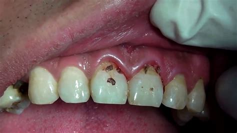 Black Stains On Teeth Near Gums Teethwalls 9DA