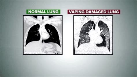 Vaping Crisis: What a single puff could do to your lungs - Hawai‘i ...