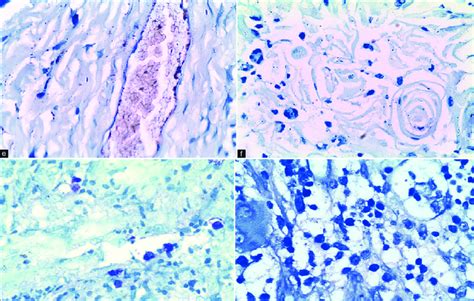 Demonstration Of Mast Cells Stained With Toluidine Blue Stain In Normal