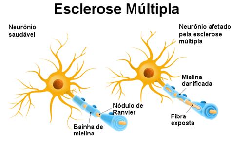 Esclerose Lateral Amiotr Fica Ou Ela Mundo Educa O