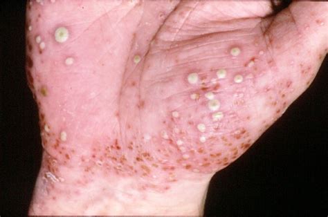 5 Jenis Psoriasis Yang Belum Kamu Ketahui Pelangikoin Lounge