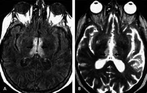 Irm C R Brale En S Quence T Flair Hypersignal P Riventriculaire V