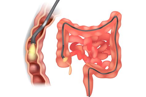 Colonoscopy And Bowel Screening Ballarat — Specialist Centre Ballarat