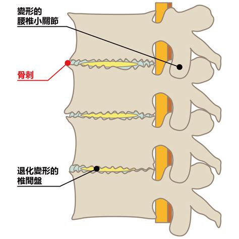 椎管狹窄症 原因、治療 Nlc野中腰椎醫院