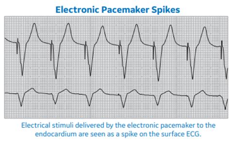 Arrhythmia Recognition Part 2 Clinical View