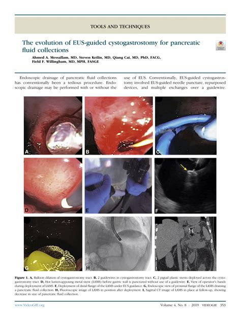 Pdf The Evolution Of Eus Guided Cystogastrostomy For Pancreatic Fluid Collections