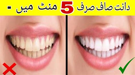 Teeth Whitening At Home In 5 Minutes How To White Teeth At Home In Urdu