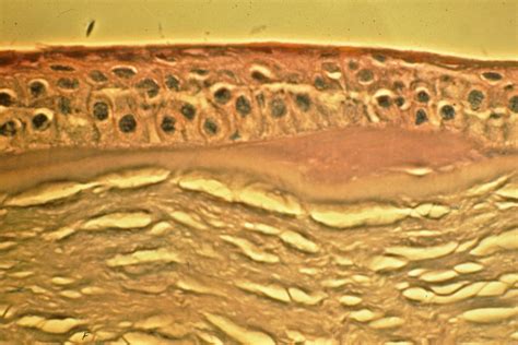 Epithelial Basement Membrane Dystrophy Pathology