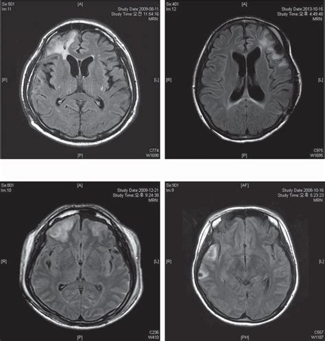 The representative MRI images of each TBI group. (A) Right frontal ...