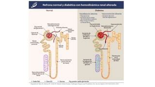 Enfermedad Renal Diabética Nefropatía diabética pptx