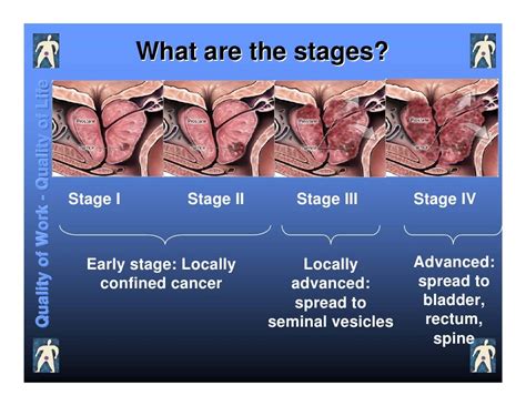 Prostate Cancer Stage 1