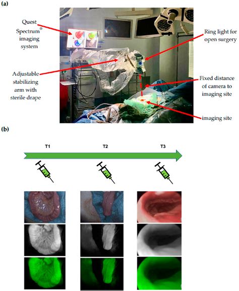 Figure From Perfusion Visualization During Ileal J Pouch Formationa