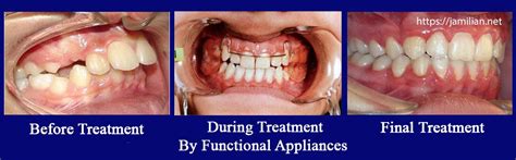 Functional Appliances Orthodontics Functional Appliances Dr Jamilian