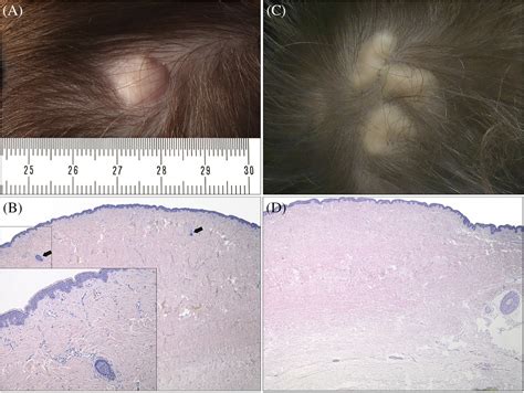 Aplasia Cutis Congenita Of The Scalp Histopathologic Features And