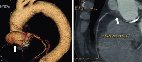 Angio Tc Dell Aorta Toracica Ricostruzione Volume Rendering A