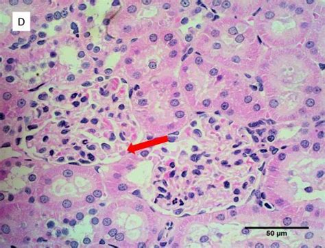 Gambaran Histopatologi Ginjal Tikus Putih Yang Diinduksi Karsinogen